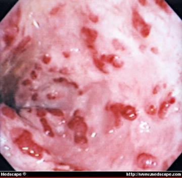 Colonic bacillary angiomatosis