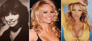 Pamela AndersonCelebrity Plastic Surgery  