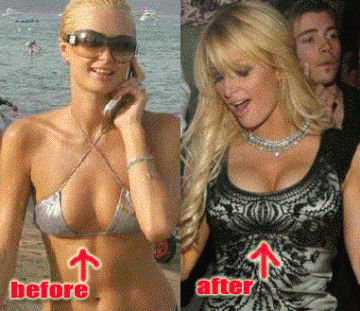 Paris HiltonCelebrity Plastic Surgery  