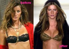 Giselle BundchenCelebrity Plastic Surgery  