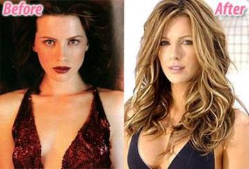 Kate BeckinsaleCelebrity Plastic Surgery  