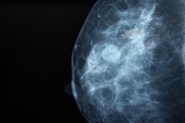 Mammogram