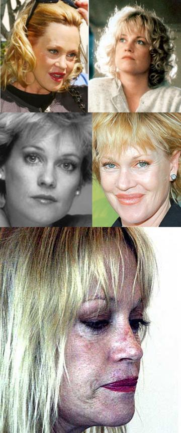 Bad Celebrity Plastic Surgery: Melanie Griffith Awful Plastic Surgery 