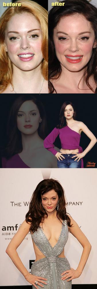 Bad Celebrity Plastic Surgery: Rose McGowan Awful Plastic Surgery 