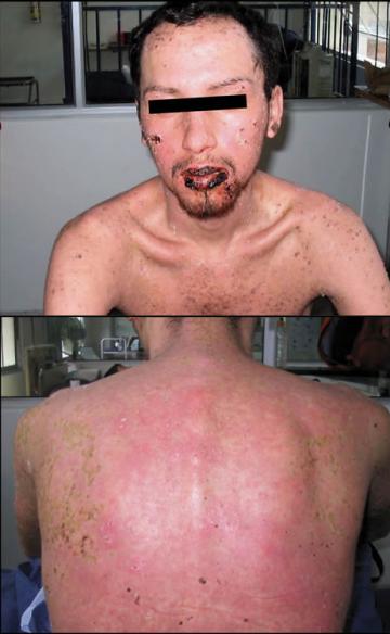 Toxic epidermal necrolysis 