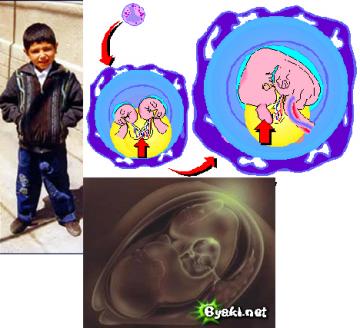 Alamjan Nematilaev (post surgery)Diagram of Foetus in Foetu 